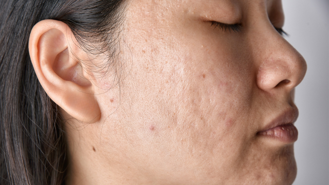 Emu Oil for Acne-Prone Skin